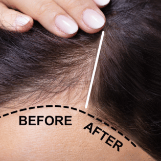 PRP & PRF Therapy Injaction